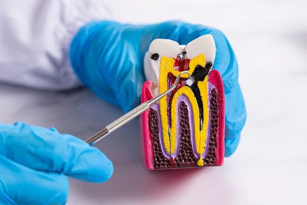 Do I Need Endodontics?