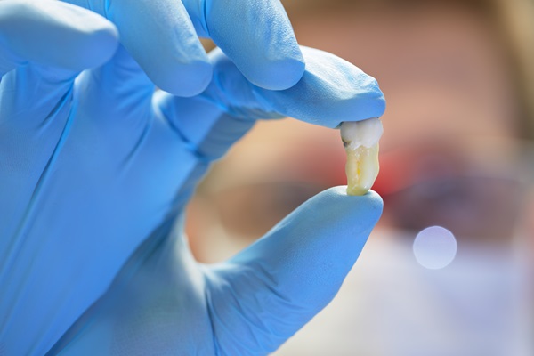 When Is A Tooth Extraction Necessary?